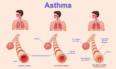 Astım anatomisi. Sağlıklı ve sağlıksız bronşlarda astım krizinin aşamalarını gösteren tıbbi şema. Solunum problemleri ve solunum kası sıkışması. Çizgi film düz vektör çizimi