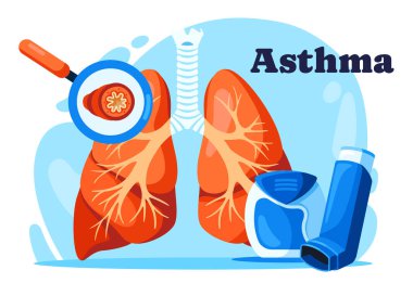 Astım Hastalığı. Astım krizi ve ilaçla solunum cihazına bağlı bronşla birlikte akciğerlerin anatomik yapısına sahip tıbbi pankart. Tedavi ve önleme. Çizgi film düz vektör çizimi