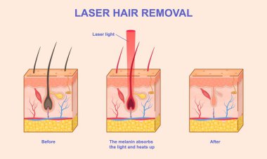 Lazer tüy aldırma. Lazer ışını kullanarak deri katmanlarını ve saç çıkarma işlemini gösteren bilgi grafikleri. Kozmetoloji prosedürü. Arkaplanda izole edilmiş Isometric 3D vektör illüstrasyon koleksiyonu