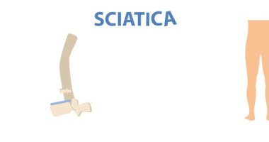 Sırtında siyatik sinir ağrısı var. Omurga ve bel fıtığı olan ve sinirlere baskı yapan eğitici tıbbi bilgi grafikleriyle hareket eden bir pankart. Acı ve hastalık. Düz grafik çizgi film