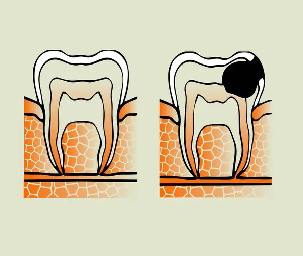 悪い歯のベクトルイラスト — ストックベクタ