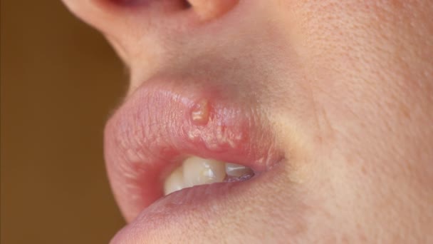 单纯性疱疹致上唇水泡的详细视图 一个带有病毒疱疹的年轻女人的脸的一部分 嘴唇上的单纯疱疹 无法辨认的唇疱疹患者 — 图库视频影像