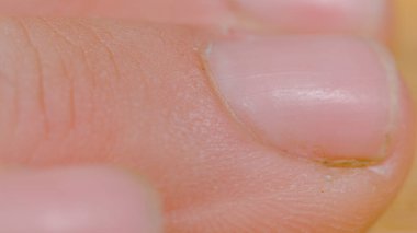 MACRO, DOF: Unrecognizable person with hands damaged from intensive manual labor rest their fingers on the desk. Highly detailed view of a hard-working person's chapped and cracked fingers and nails.