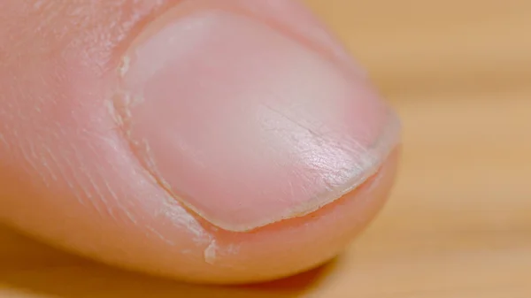 Macro Dof 勤勉な人の指のき裂した皮膚の詳細なショット 高精細は 認識できない白い人のチャップ指のビューを閉じます 手作業による指の損傷 — ストック写真