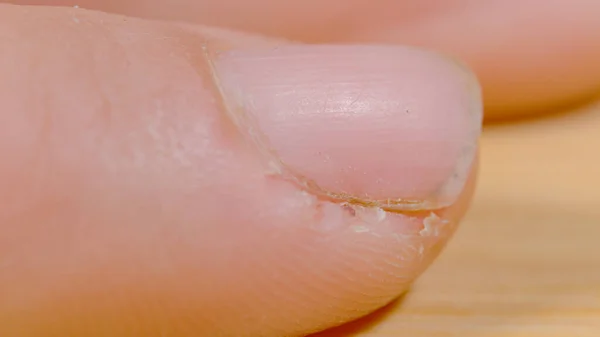 Macro Dof 手作業による指の損傷 高精細は 認識できない白い人のチャップ指のビューを閉じます 彼らの指の勤勉な人の皮の詳細なショット — ストック写真
