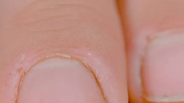 Macro Dof 認識できない白い人のチャップ指の高解像度のクローズアップビュー 彼らの指の勤勉な人の割れ肌の詳細なショット 手作業による指の損傷 — ストック写真