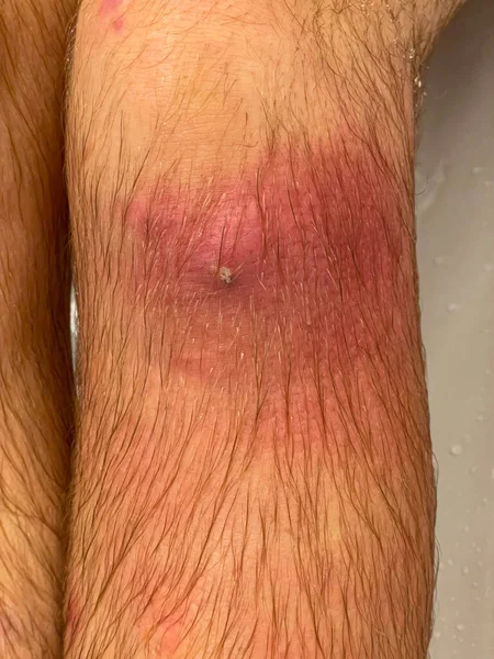 閉じる 男性の膝の上の小さなカットは 感染し 黄色のプッシュでいっぱい取得します 大人の男性の膝の詳細なショットは 感染し 細菌でいっぱい取得します 感染した手足の閉鎖 — ストック写真