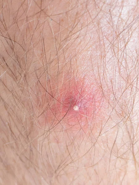 Vertical Close Detailed Shot Adult Male Knee Gets Infected Filled — Stock fotografie