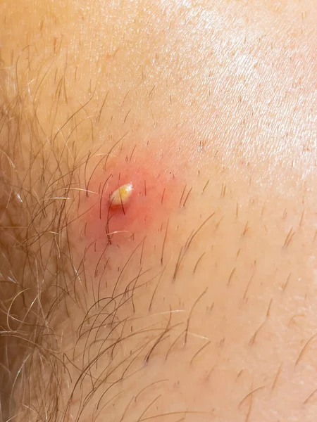 VERTICAL, CLOSE UP: Partially shaved leg hair reveals an infected spot on a man\'s knee. White abscess fills up an infected wound on a male patient\'s lacerated leg. Detailed view of an infected injury.