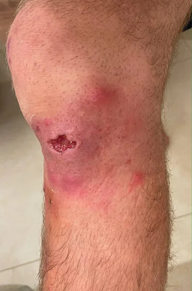 VERTICAL, CLOSE UP: Drainage site of an infected bruise on a male patient\'s knee slowly heals during the recovery process. Healing raw flesh is visible inside of a gaping hole in a grown man\'s knee.