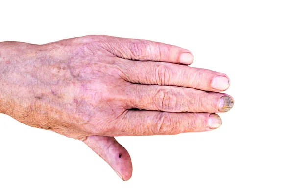 Malattie Alle Unghie Vecchie Mani Sporche Senzatetto Isolare Uno Sfondo — Foto Stock