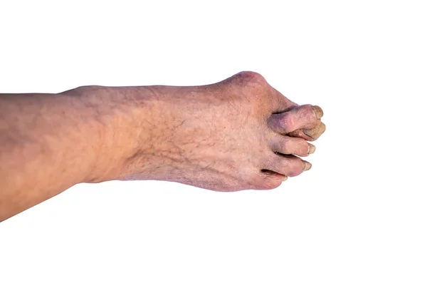 Nagelkrankheit Alter Schmutziger Fuß Obdachloser Fingerfehler Isolieren Auf Weißem Hintergrund — Stockfoto