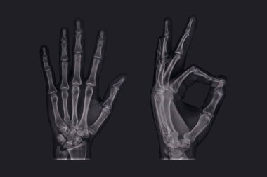 Koyu renk X-ışını insan parmak izi tamam işareti. 