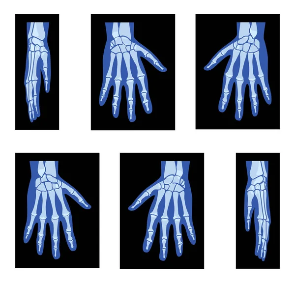 一套X光手骷髅人体 骨瘦如柴的成年人前卫后视镜 医学解剖学在黑色背景下的三维逼真平面蓝色概念矢量图解 — 图库矢量图片