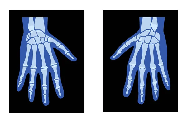 X射线手骷髅人体 骨骼成年人伦琴回视 长枪3D逼真的平面蓝色概念载体在黑色背景下隔离的医学解剖学图解 — 图库矢量图片
