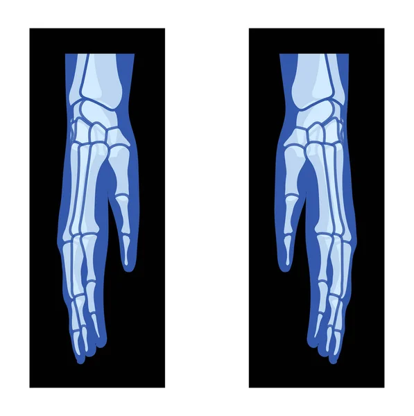 X線手と半径 ウルナスケルトン人間の体 骨大人の人々のRoentgen側のビュー 3Dリアルなフラットブルーカラーコンセプト黒の背景に隔離された医学解剖学のベクトルイラスト — ストックベクタ