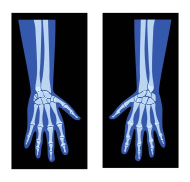 Radius 'la X-Ray Hands, Ulna İskelet İnsan vücudu, Kemikler yetişkin insanların ön görüntüsü. Siyah zemin üzerinde izole edilmiş tıbbi anatominin 3D gerçekçi düz mavi renk konsepti Vektör illüstrasyonu