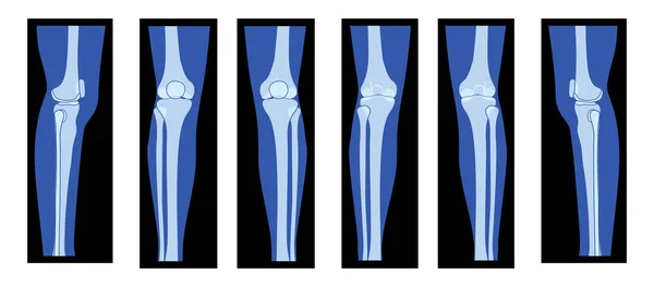 Set Ray Knee Femur Leg Skeleton Human Body Patella Epicondyle — Stock Vector