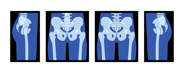 X線骨盤と女性のスケルトンヒップ人間の体骨大人の人々の後ろ側のビューにRoentgenフロントのセット 3Dリアルなフラットブルーカラーコンセプト黒で隔離された医学解剖学のベクトルイラスト — ストックベクタ
