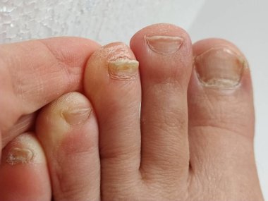 Mantar tırnağı enfeksiyonlu onychomycosis. Onikomikozis ve kuru cilt. Candida mantarı kaşıntıya, çatlaklara, kızarıklığa ve deri parçacıklarının dökülmesine neden oldu. Dermatolojik sorun.