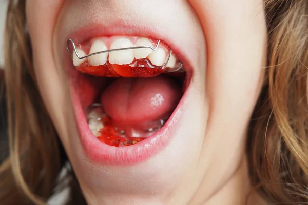 Protesi Ortodontica Protesi Metallo Plastica Sulle Fauci Una Bambina Caucasica — Foto Stock