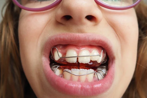Protesi Ortodontica Protesi Metallo Plastica Sulle Fauci Una Bambina Caucasica — Foto Stock