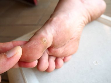 Bitki siğilleri insan papillomavirüslerinin sebep olduğu siğiller taban ve ayak parmaklarında görülür. Ayak tabanının yenilmesi, sert ve pürüzlü papüller, papiller desenleri yok eder.
