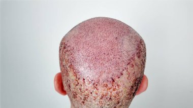 İşlem sonrası erkek saç nakli. Donör ve alıcı kafa bölgesine bakın..