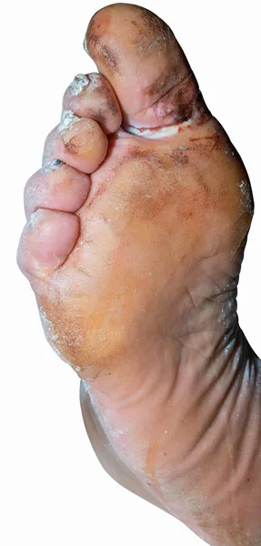 Поранена Нога Літнього Чоловіка Білому Тлі — стокове фото