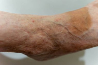 Close examination of an older person's arm showcasing prominent veins, skin textures, and discoloration. The lighting highlights various skin tones and natural features present. clipart