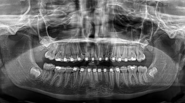Panoramik X-ray (ortomografi) diş hekimliği alanında olası oral komplikasyonları analiz etmek için diş telleri (metal parantez) ile 14 yaşındaki bir kızın diş yapısını gösteriyor