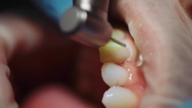 Profesyonel diş sağlığı kliniğinde dişçi aletlerini kullanırken çekilmiş yakın çekim görüntüleri. Hastanın dişini delen doktor. İçeride. Tıp konsepti. Dişçilik