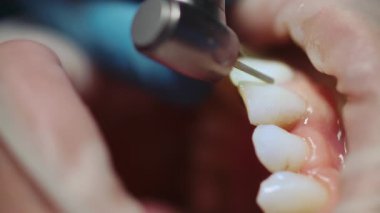 Dişçi muayenehanesinde diş tedavisi gören hastayı kapatın. Dişler. Sağlığa. Diş ağrısı. Modern klinik