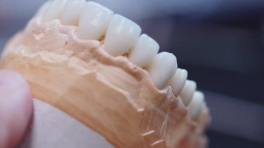 Diş hekiminin elleri, takma dişler üzerinde çalışan çene modeline diş tacı takıyor. Ortodontikti. İmplantlar