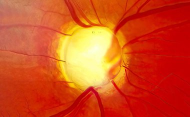 Optic nerve in advanced glaucoma disease clipart