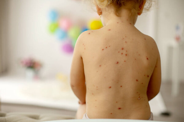 Little toddler girl with chickenpox in bed, playing at home, quarantine isolation during sickness, Varicella zoster virus or Chickenpox bubble rash