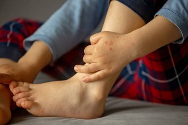 Deri döküntüsü, gül, el ve ağız hastalığı, çocuk döküntüsü.