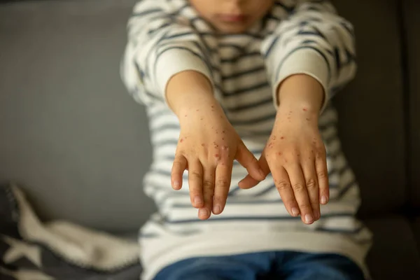 Child with skin rash, roseola, Hand-foot-and-mouth disease, child rash disease