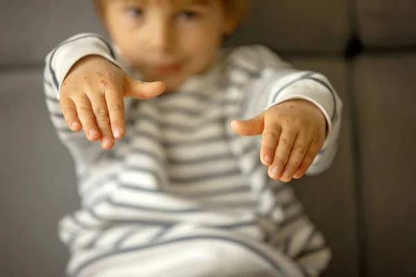 Child with skin rash, roseola, Hand-foot-and-mouth disease, child rash disease