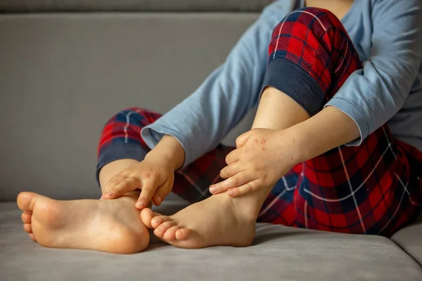 Kind Mit Hautausschlag Roseola Hand Maul Und Klauenseuche Kinderausschlag — Stockfoto
