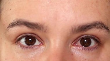 Konjonktivit, grip, soğuk algınlığı veya alerjiden etkilenen bir kadının kırmızı gözü.