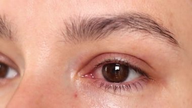 Konjonktivit, grip, soğuk algınlığı veya alerjiden etkilenen bir kadının kırmızı gözü.