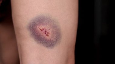 Bacağında büyük bir çürük ve yara var.