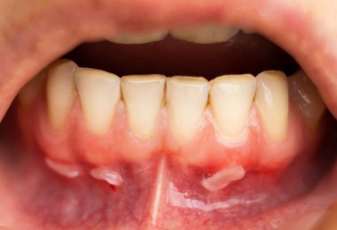 Diş etlerinde sorun var. İltihap ve mide iltihabı.
