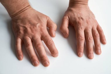 Eklem iltihabı ve deri iltihabı belirtileri gösteren tahriş olmuş ve parmak deformasyonu olan erkek ellerinin yakın çekimi. Tıbbi eklem hastalığı, romatizma veya el yaralanması kavramı