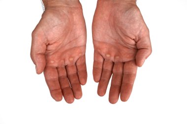 Close-up of male hands with calluses on palms, isolated on white background. Concept of hard work, manual labor, rough skin, strength, effort, and perseverance.