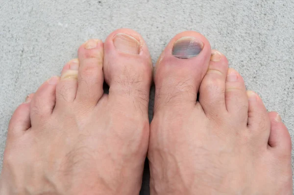 toe nail bruise hemtoma. subungal toe nail bruise hemtoma. closeup of toe nail bruise hemtoma. toe nail bruise hemtoma on feet.