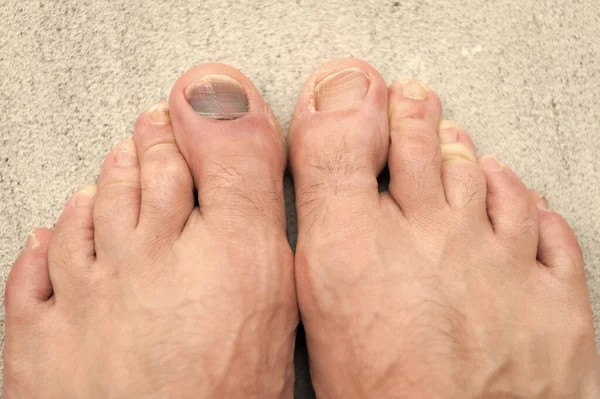 toe nail bruise hemtoma. subungal toe nail bruise hemtoma. closeup of toe nail bruise hemtoma. toe nail bruise hemtoma on feet.