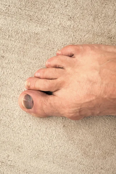 Closeup Toe Nail Bruise Hemtoma Toe Nail Bruise Hemtoma Foot — Foto Stock