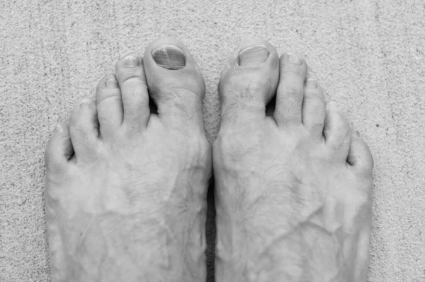Subungal Toe Nail Bruise Hemtoma Closeup Toe Nail Bruise Hemtoma — Foto Stock